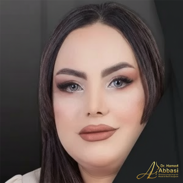 نمونه جراحی بینی دکتر حامد عباسی