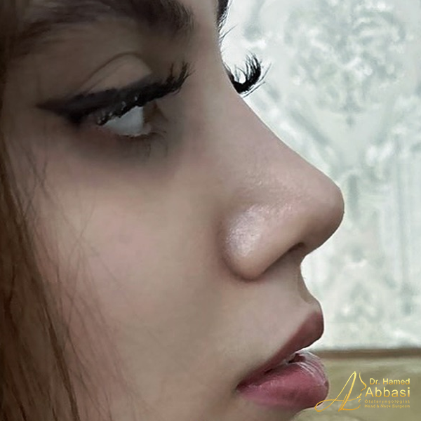 نمونه جراحی بینی دکتر حامد عباسی