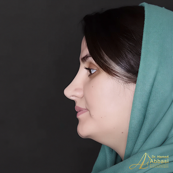 نمونه جراحی بینی دکتر حامد عباسی