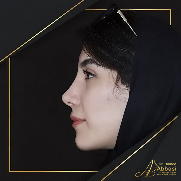 نمونه جراحی بینی دکتر حامد عباسی