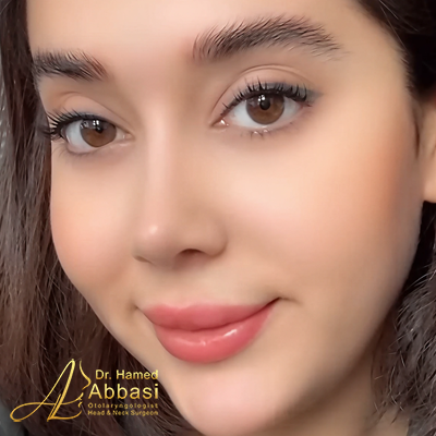 تصاویر عمل جراحی بینی دکتر عباسی