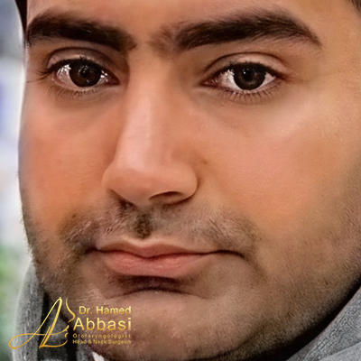 تصاویر عمل جراحی بینی دکتر عباسی