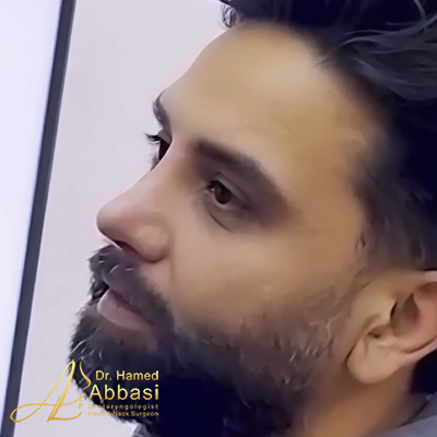تصاویر عمل جراحی بینی دکتر عباسی