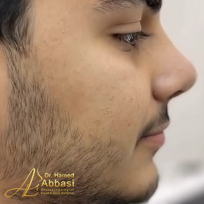 تصاویر عمل جراحی بینی دکتر عباسی