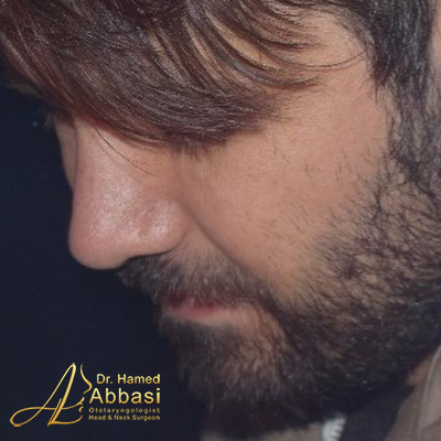 تصاویر عمل جراحی بینی دکتر عباسی