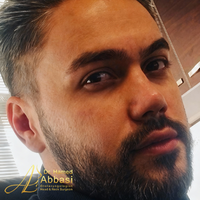 تصاویر عمل جراحی بینی دکتر عباسی