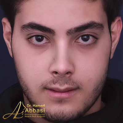 تصاویر عمل جراحی بینی دکتر عباسی