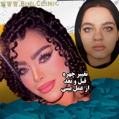 تغییر چهره قبل و بعد از عمل بینی