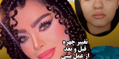 تغییر چهره قبل و بعد از عمل بینی