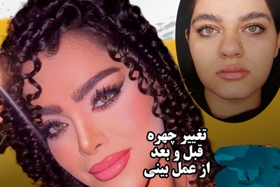 تغییر چهره قبل و بعد از عمل بینی