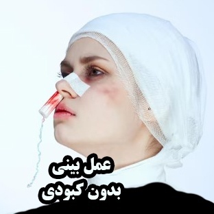 جراحی بینی بدون کبودی؛ آیا واقعاً ممکن است؟