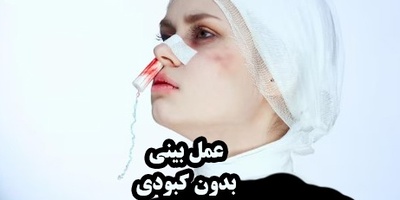 جراحی بینی بدون کبودی؛ آیا واقعاً ممکن است؟