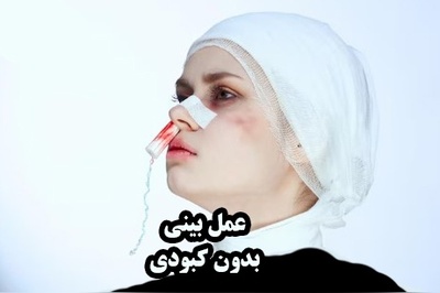 جراحی بینی بدون کبودی؛ آیا واقعاً ممکن است؟