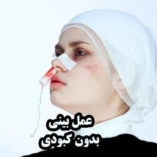 جراحی بینی بدون کبودی؛ آیا واقعاً ممکن است؟