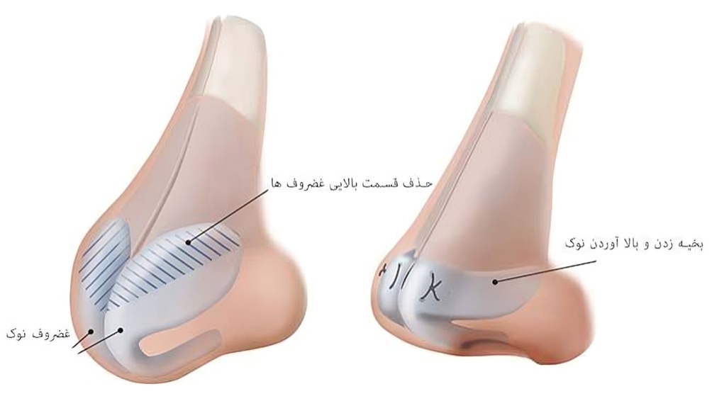 غضروف بینی