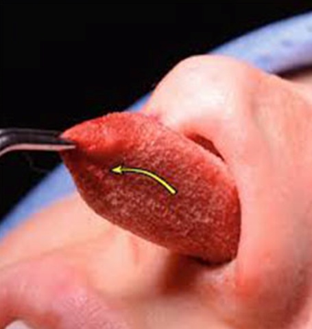 عمل بینی بدون تامپون