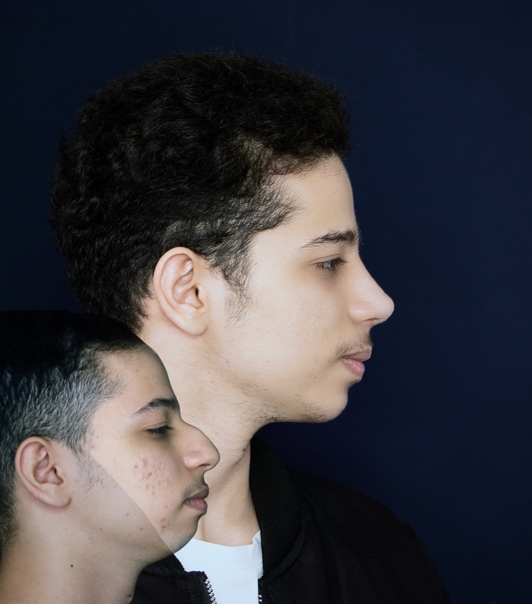 انحراف بینی پس از عمل