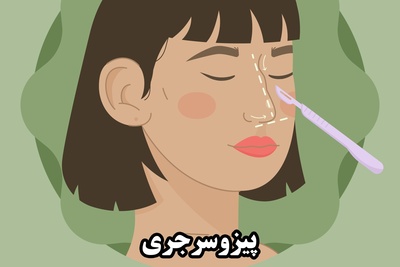 بهترین روش جراحی بینی در سال 1404 : پیزوسرجری بینی