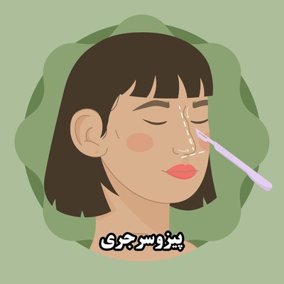 بهترین روش جراحی بینی در سال 1404 : پیزوسرجری بینی