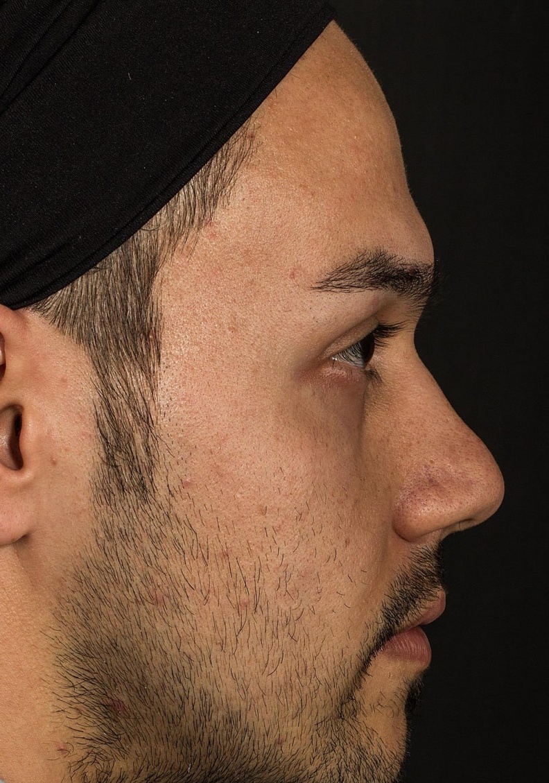 اصول جراحی بینی مردانه