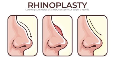 همه چیز درباره عمل بینی طبیعی؛ از مشاوره تا نتیجه نهایی