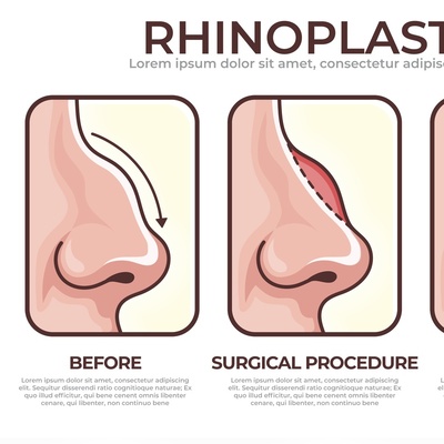 همه چیز درباره عمل بینی طبیعی؛ از مشاوره تا نتیجه نهایی