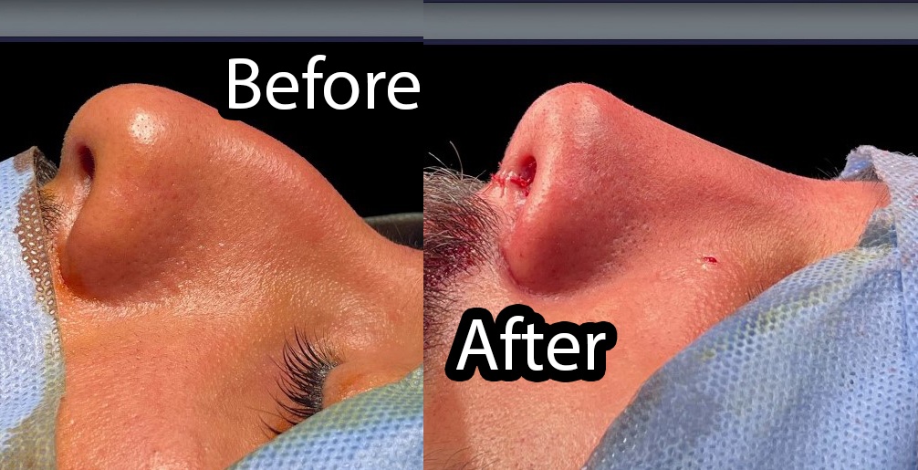 عمل بینی مردانه ؛ حفظ جذابیت و فرم طبیعی چهره