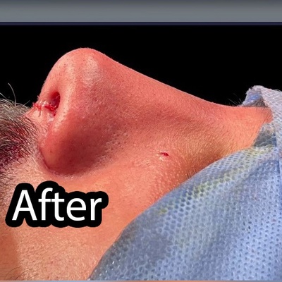 عمل بینی مردانه ؛ حفظ جذابیت و فرم طبیعی چهره