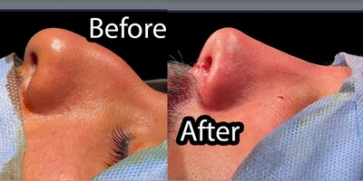 عمل بینی مردانه ؛ حفظ جذابیت و فرم طبیعی چهره