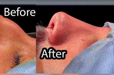 عمل بینی مردانه ؛ حفظ جذابیت و فرم طبیعی چهره