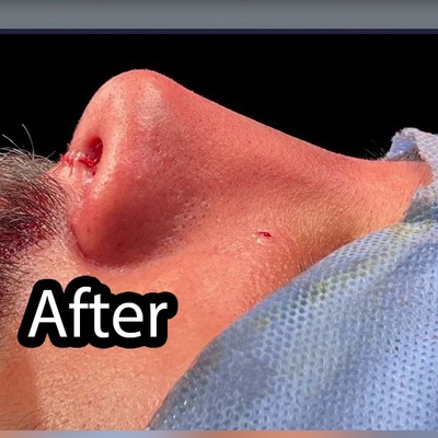 عمل بینی مردانه ؛ حفظ جذابیت و فرم طبیعی چهره