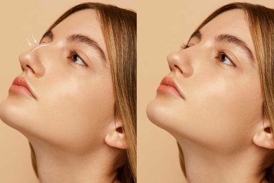 لیفت بینی چیست؟ روش‌ها، مزایا و معایب لیفت بینی