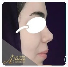 بیینی طبیعی