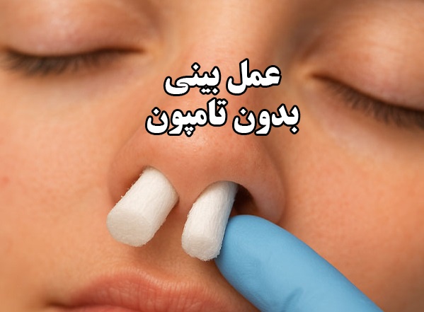 جراحی رینوپلاستی بدون تامپون : مزایا، شرایط و نکات مهم انتخاب