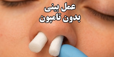جراحی رینوپلاستی بدون تامپون : مزایا، شرایط و نکات مهم انتخاب