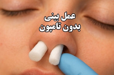 جراحی رینوپلاستی بدون تامپون : مزایا، شرایط و نکات مهم انتخاب