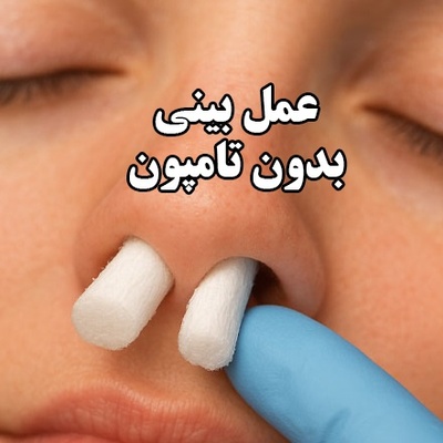 جراحی رینوپلاستی بدون تامپون : مزایا، شرایط و نکات مهم انتخاب