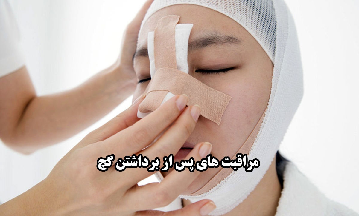 مراقبت از بینی بعد از برداشتن گچ