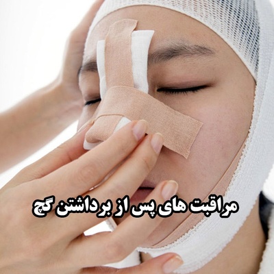 مراقبت از بینی بعد از برداشتن گچ