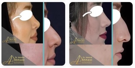 قبل و بعد از عمل بینی