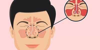 جراحی سپتوپلاستی چیست؟ هر آنچه باید درباره عمل انحراف تیغه بینی بدانید