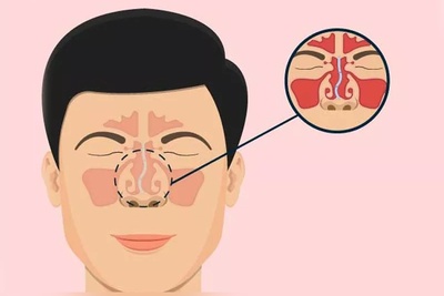 جراحی سپتوپلاستی چیست؟ هر آنچه باید درباره عمل انحراف تیغه بینی بدانید