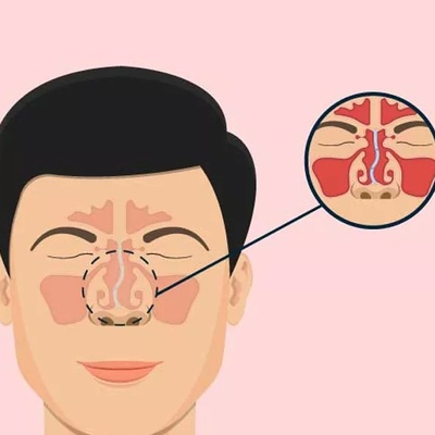 جراحی سپتوپلاستی چیست؟ هر آنچه باید درباره عمل انحراف تیغه بینی بدانید