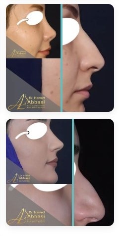 قبل و بعد از عمل بینی