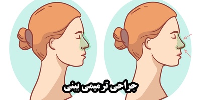 جراحی بینی ترمیمی؛ ترمیم فرم و عملکرد پس از جراحی قبلی
