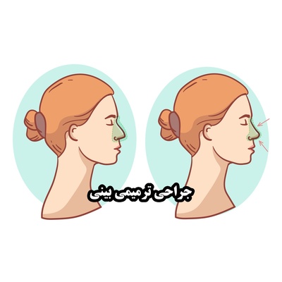 جراحی بینی ترمیمی؛ ترمیم فرم و عملکرد پس از جراحی قبلی