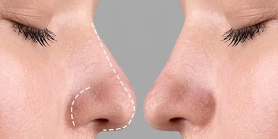 بینی کلیپسی بعد از عمل چیست؟ علت ایجاد و روش اصلاح آن