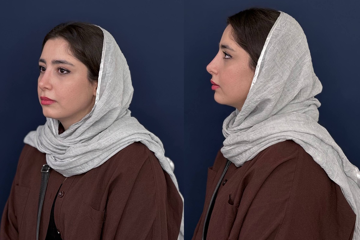 جراحی بینی بدون تامپون چگونه انجام می شود؟