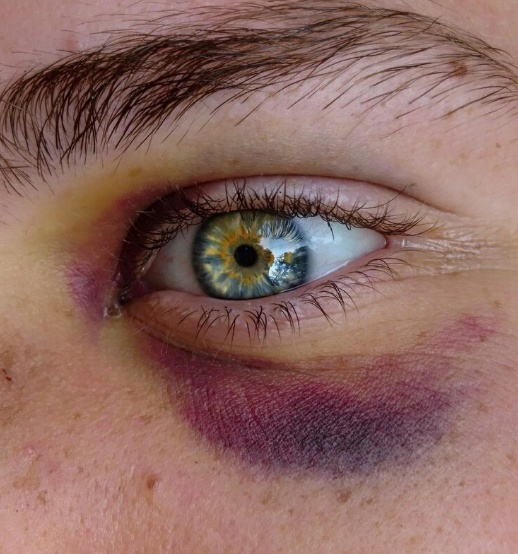 تکنیک‌های مدرن برای کاهش کبودی