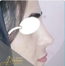 بعد از ترمیم